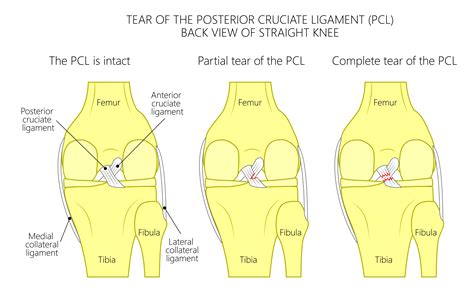 It prevents the tibia from sliding out in front of the femur and provides rotational stability to the knee. . Acl near me